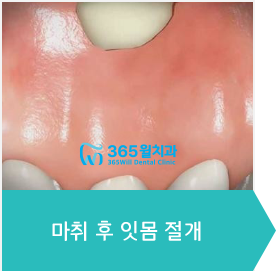 2.마취 후 잇몸 절개