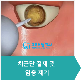 3.치근단 절제 및 염증 제거