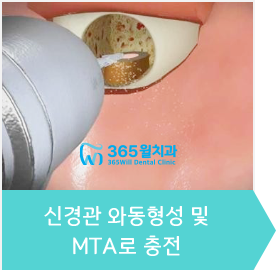 4.신경관 와동형성 및 MTA로 충전