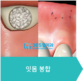 5.잇몸 봉합